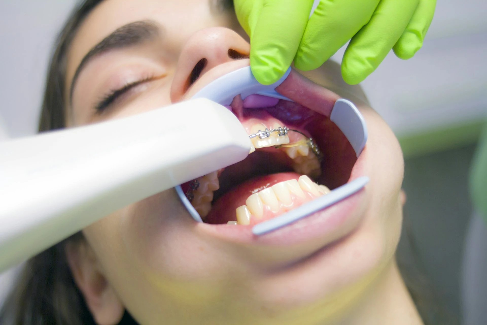 Orthodontische behandeling met een beugel
